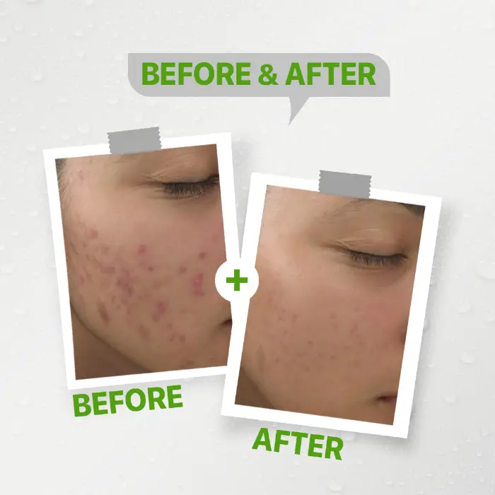 فيتابلاي كريم لعلاج حب الشباب 40 جرام